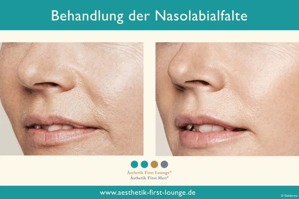 Unterspritzung Der Nasolabialfalte Mit Hyaluron Von Dr